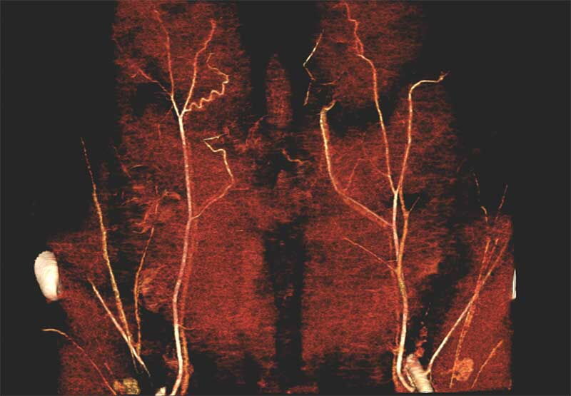 Ein Bild von Blutgefäßen im menschlichen Körper, dargestellt durch eine digitale Angiographie.