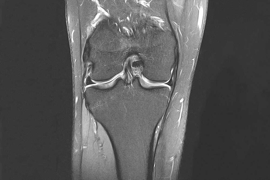 Das Bild zeigt ein MRT eines menschlichen Knies, mit Fokus auf Bänder und Gelenkstruktur.