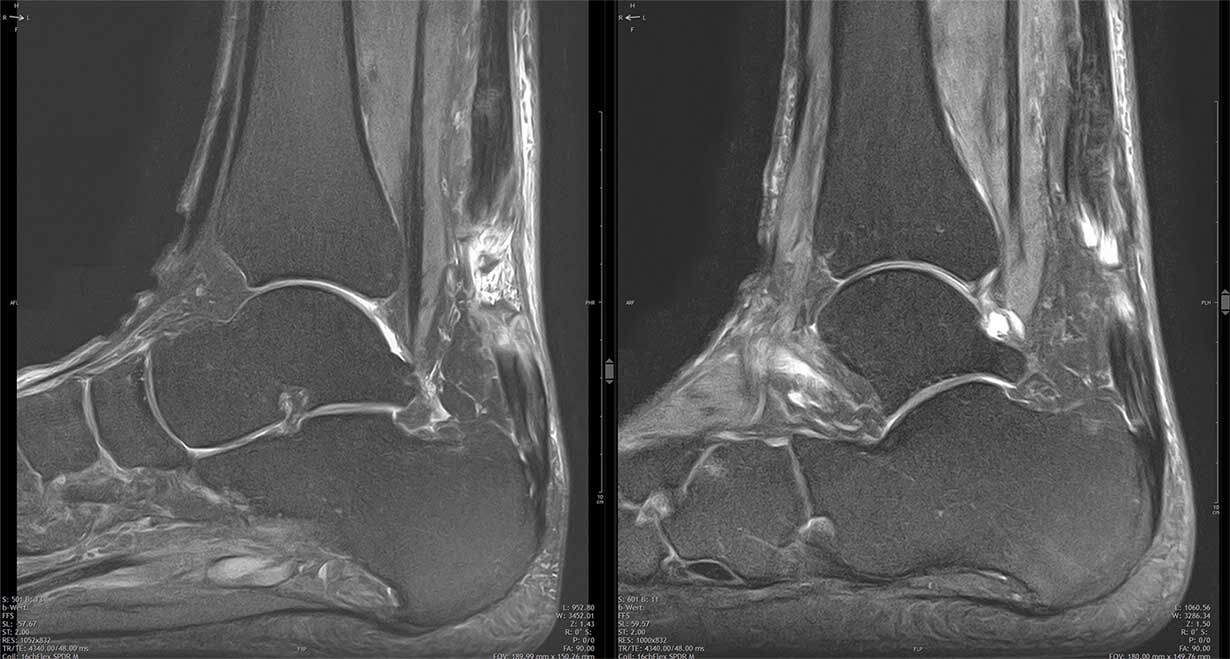 . Zwei MRT-Aufnahmen eines Knöchels mit Fokus auf Knochen und Bänder.