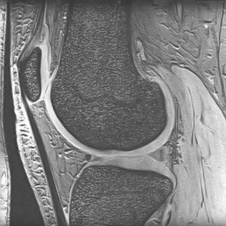 MRI eines Kniegelenks, zeigt Knochen- und Gewebestrukturen seitlich im Querschnitt.