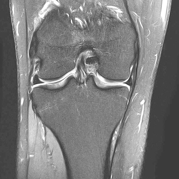 . Ein MRT-Bild eines menschlichen Knies im sagittalen Schnitt, das Knochen und Gelenkstrukturen zeigt.