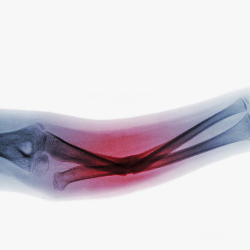 Röntgenaufnahme eines Ellenbogengelenks mit roten Bereich, der auf Schwellung oder Entzündung hindeutet.