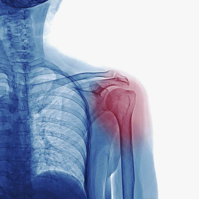 Röntgenbild einer Schulter mit roter Markierung zeigt möglichen Schmerz- oder Problembereich.