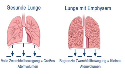 Gesunde Lunge vs. Lunge mit Emphysem; Unterschiede im Atemvolumen durch Zwerchfellbewegung.