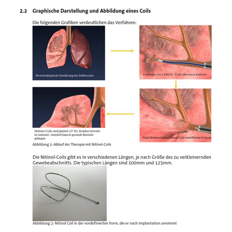 Darstellung der Implantation von Nitinol-Coils in die Lunge zur Gewebereduktion. Coils verformen sich nach Einsatz.