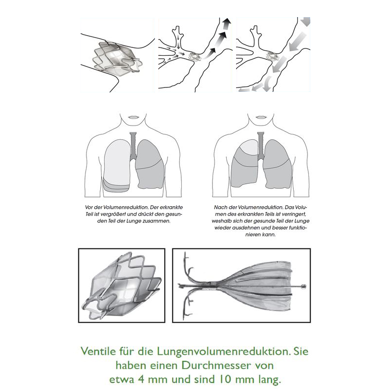 Ventile zur Lungenvolumenreduktion: 4 mm Durchmesser, 10 mm Länge. Diagramme vor/nach Reduktion, eingeengter Lungenbereich.