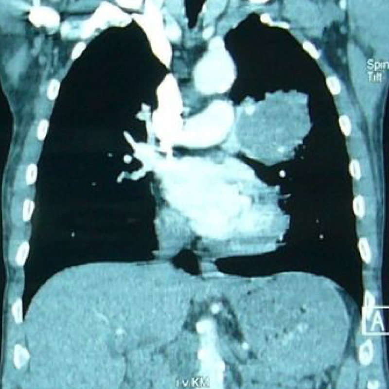 Ein Brust-CT-Scan zeigt Strukturen des Brustkorbs wie Herz, Lunge und Blutgefäße.