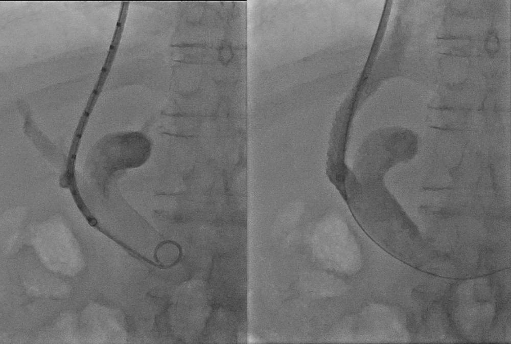 Es zeigt ein medizinisches Bild mit einem Katheter und einem Kontrastmittel in den Gelenken.