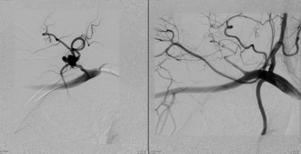 Schwarz-weiße medizinische Bildgebung, möglicherweise Angiogramm, zeigt Blutgefäße mit Kontrastmittel.