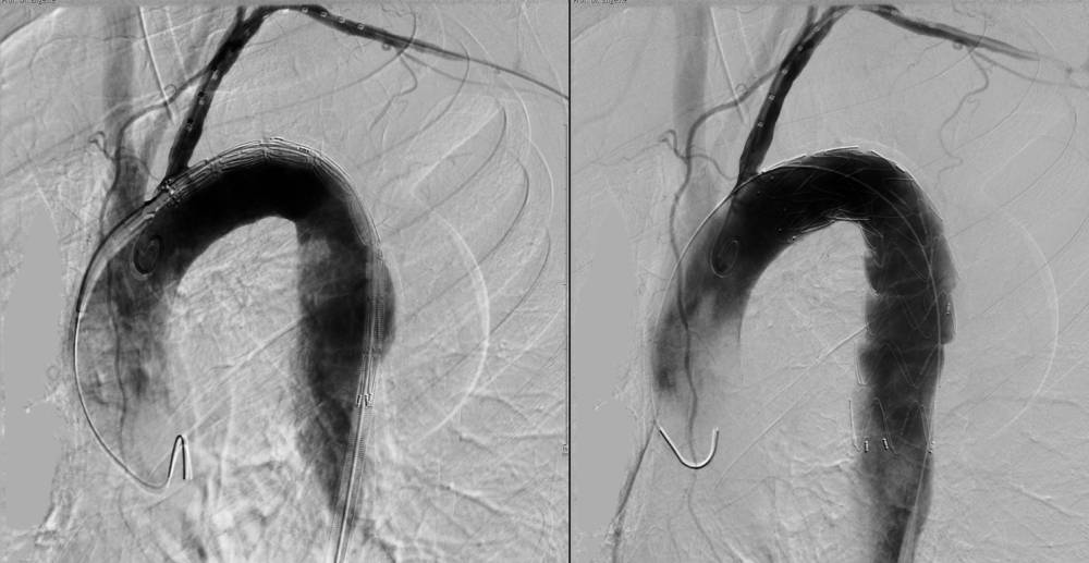 Röntgenaufnahme der Aorta mit Kontrastmittel, zeigt den Blutfluss und mögliche Anomalien.