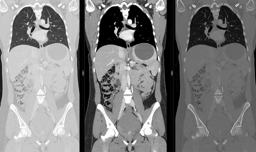 Drei CT-Bilder eines Brustkorbs mit Lungen, Herz und Bauchorganen in unterschiedlichen Durchleuchtungsstufen.