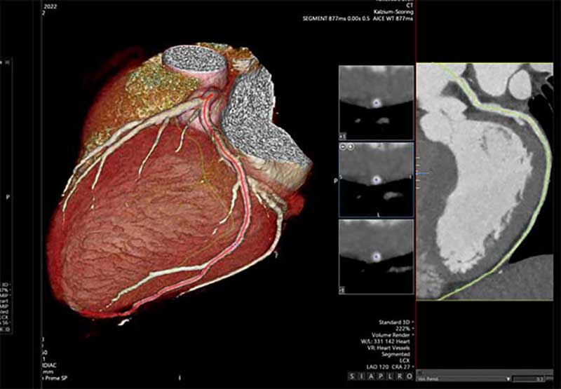 3D-Darstellung eines Herzens mit Blutgefäßen, CT-Aufnahmen zeigen Details der Herzstruktur.