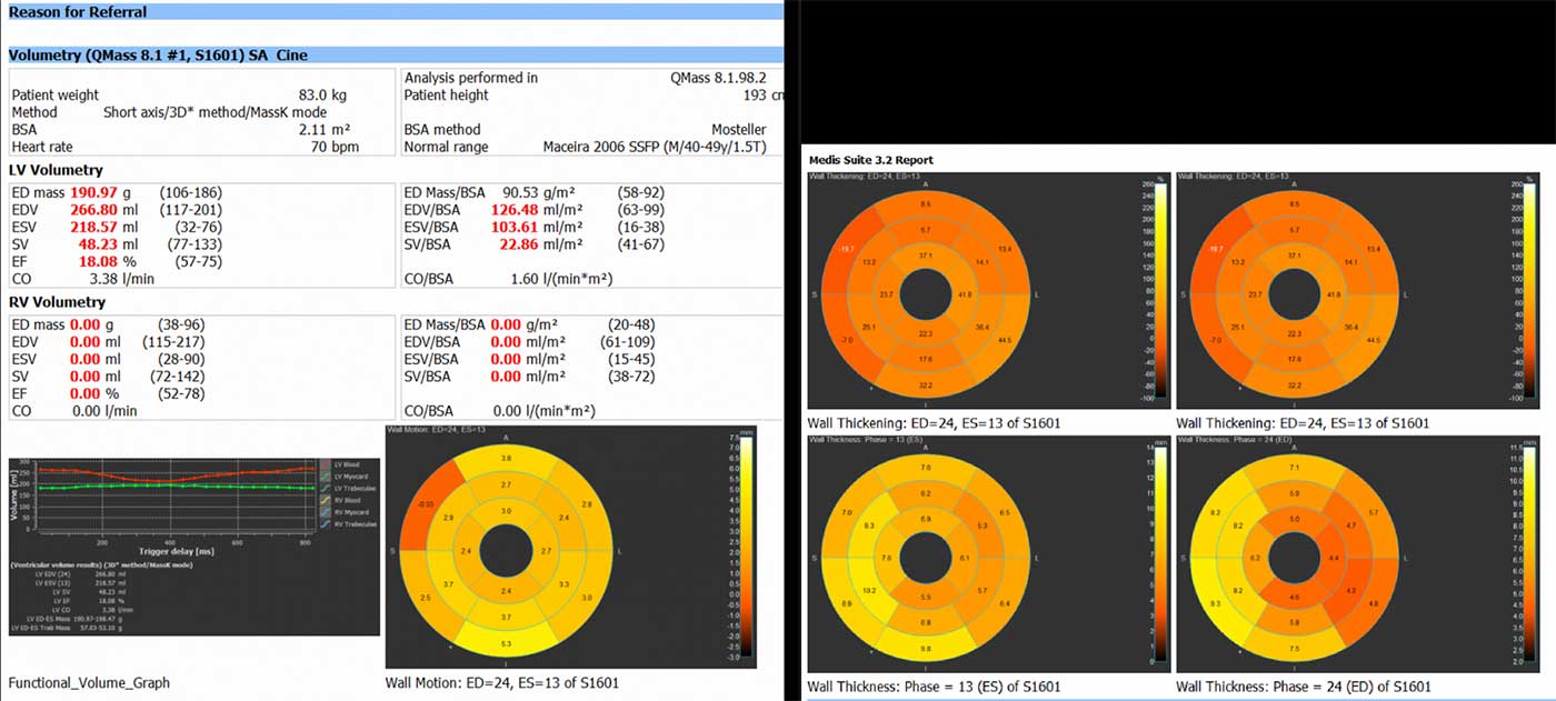 Medizinischer Bericht mit Herzvolumenmessungen, Wandverdickungsdaten und Grafiken.