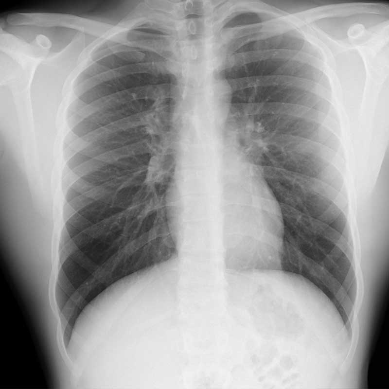 Röntgenbild eines menschlichen Brustkorbs, zeigt Rippen und Lungen.