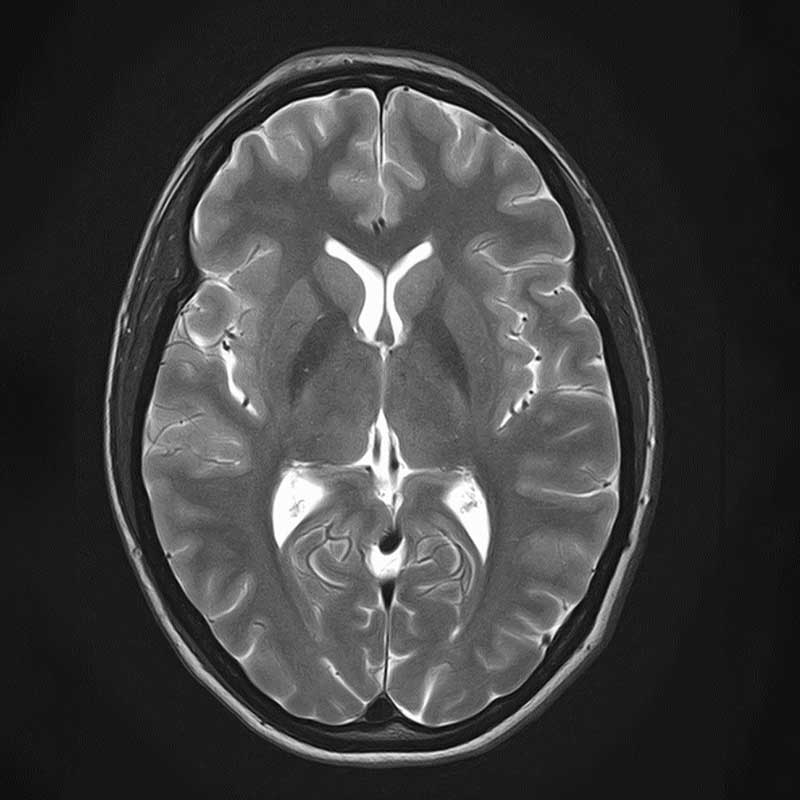 . Ein MRT-Scan eines menschlichen Gehirns, axialer Schnitt, zeigt Strukturen und Gewebe.