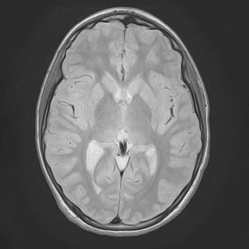 . Dies ist ein MRT-Bild eines menschlichen Gehirns in horizontaler Ansicht.