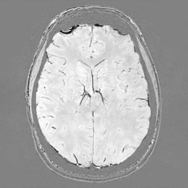 . Das Bild zeigt einen MRT-Scan des menschlichen Gehirns in axialer Ansicht.