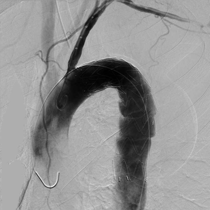 Dies ist ein Röntgenbild der Aorta mit einem eingesetzten Stent.