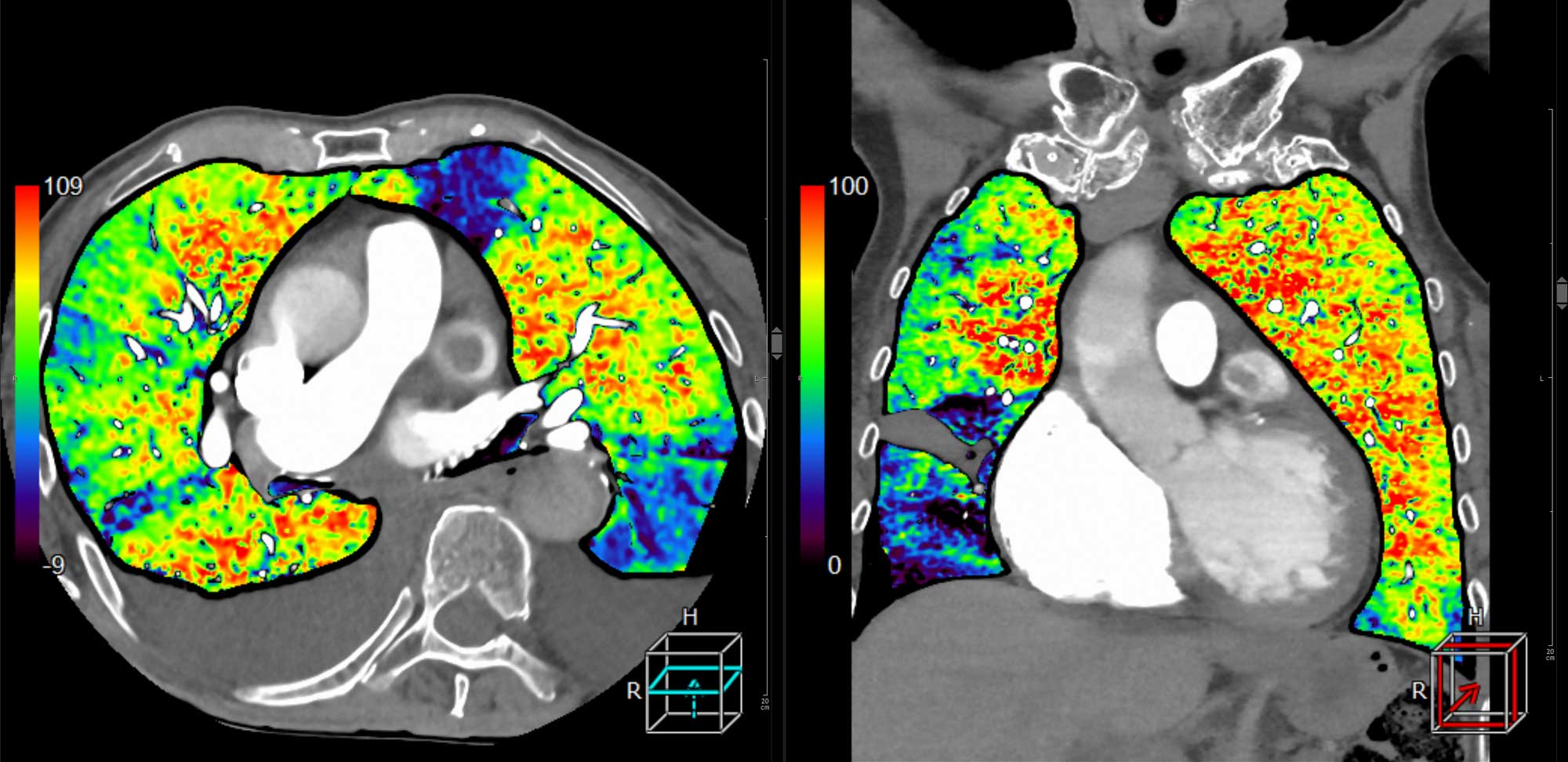 . Ein CT-Scan der Lunge in zwei Ansichten, mit farbcodierten Bereichen zur Darstellung der Gewebedichte.