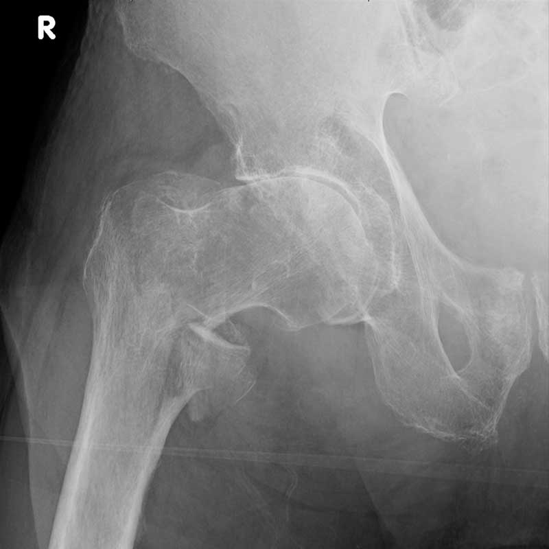 . Röntgenaufnahme eines rechten Hüftgelenks, zeigt Knochen und Gelenkstruktur.