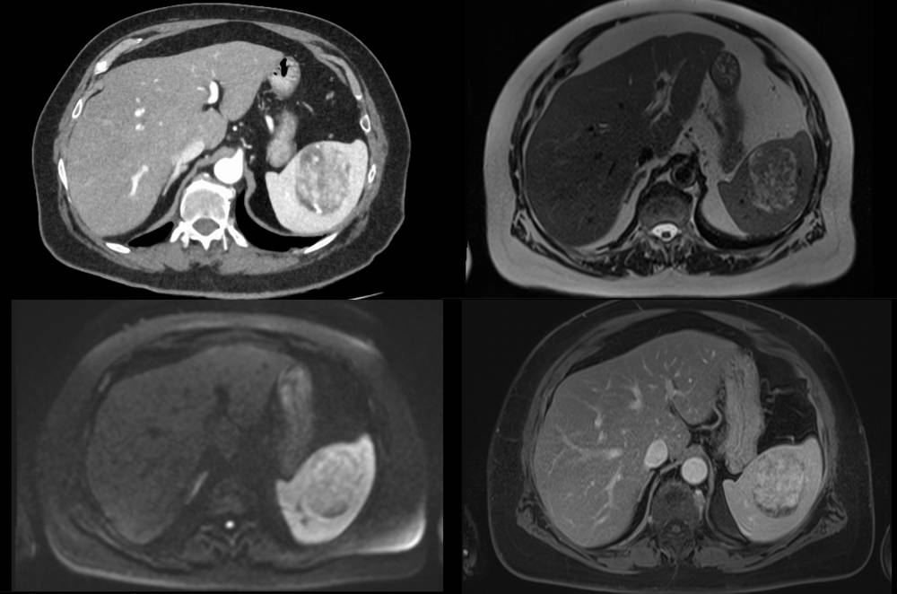 Ein CT- und MRT-Scan des menschlichen Bauchs, wahrscheinlich zur Untersuchung eines Organs.