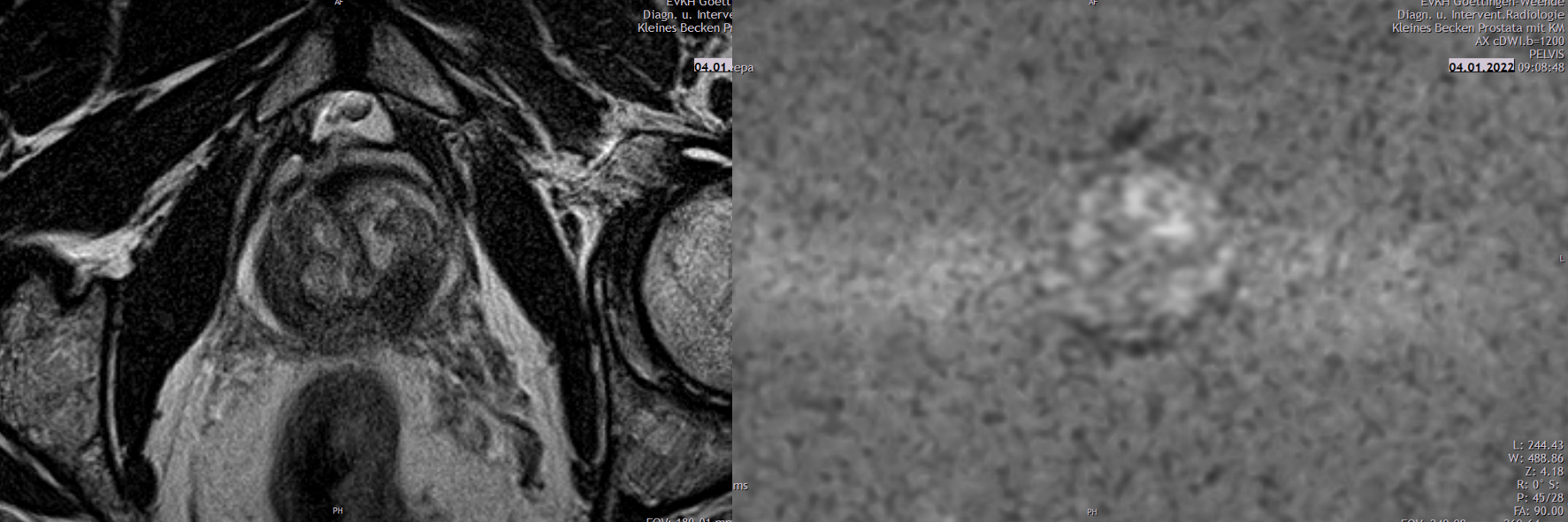 Es handelt sich um ein medizinisches MRT-Bild des Beckens, das die Prostata darstellt.