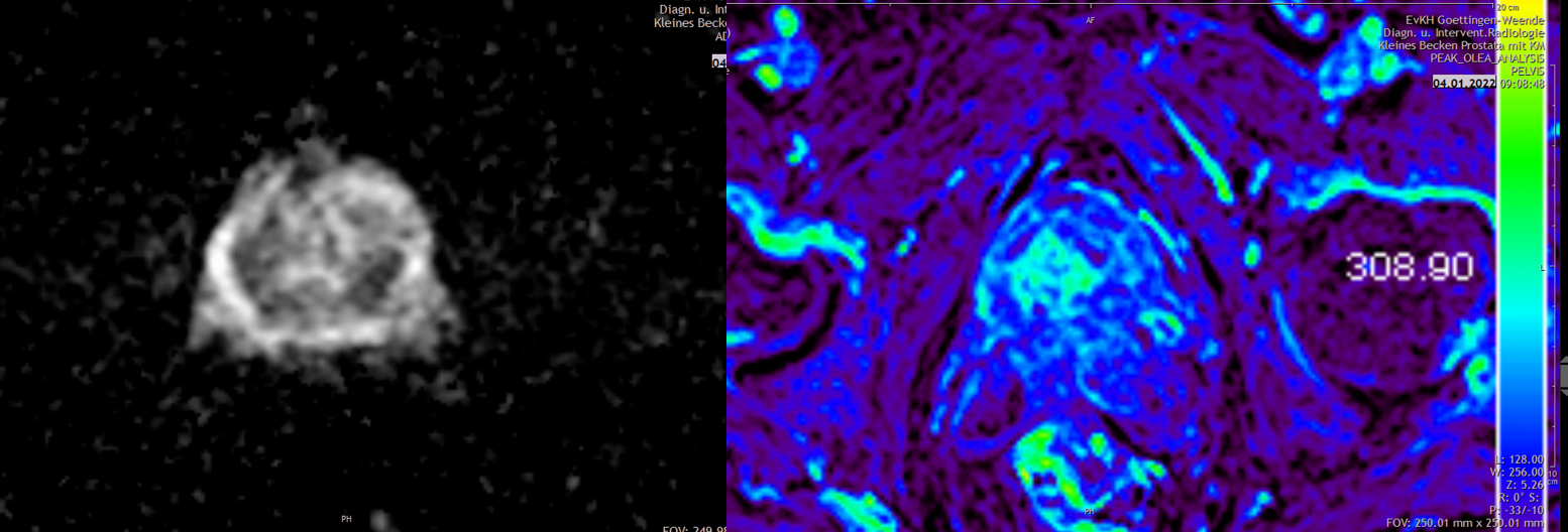 Es zeigt medizinische Bildgebung des Beckens mit farblich hervorgehobenem Bereich, möglicherweise zur Analyse von Gewebe.