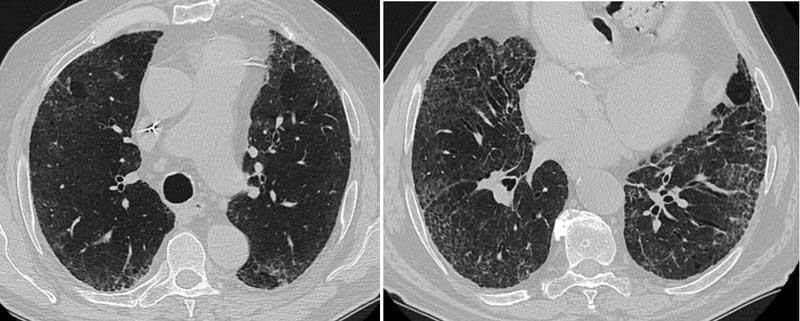 CT-Scan zeigt Lungengewebe mit unterschiedlichen Mustern, möglicherweise Darstellung einer Erkrankung oder Anomalie.