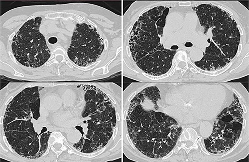 CT-Scan des Brustkorbs mit Lungenschnitten, zeigt mögliche Lungenerkrankungen.