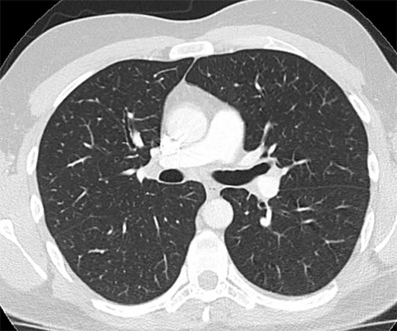 CT-Scan eines menschlichen Brustkorbs mit sichtbaren Lungenflügeln und Herz im Querschnitt.