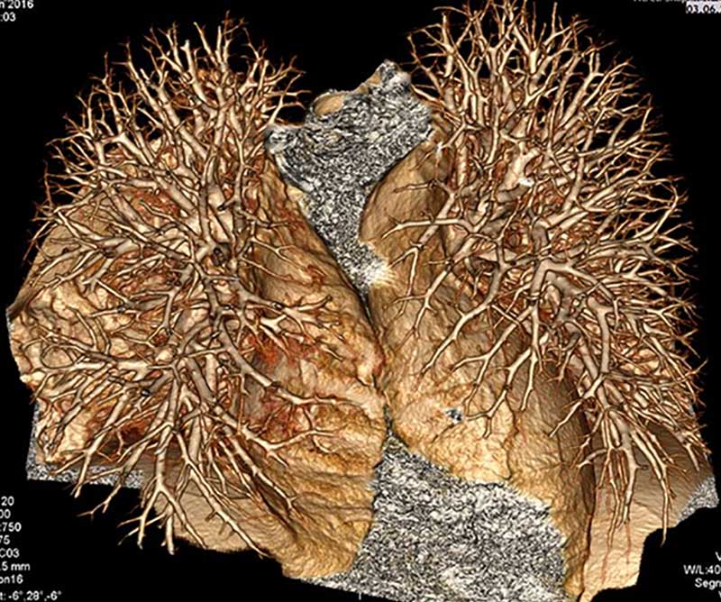 Das Bild zeigt eine 3D-CT-Scan-Darstellung menschlicher Lungen mit den Bronchialästen.