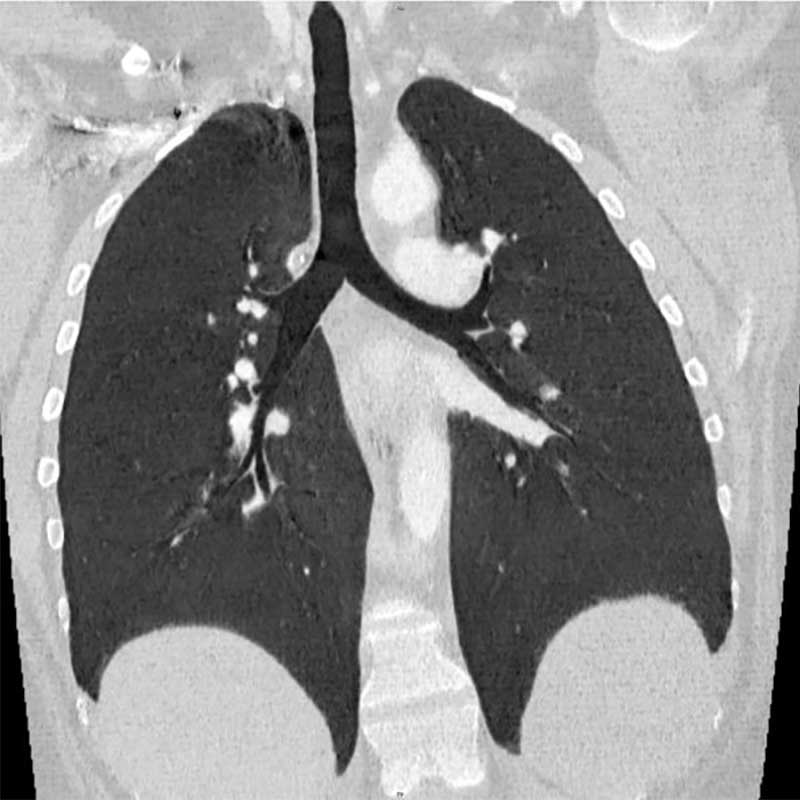 CT-Scan der Brust zeigt die Lungen und Atemwege in axialer Ansicht.