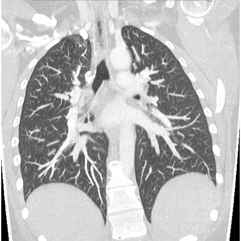 Ein CT-Scan der menschlichen Lungen mit Bronchien und Luftröhre in Frontalansicht.